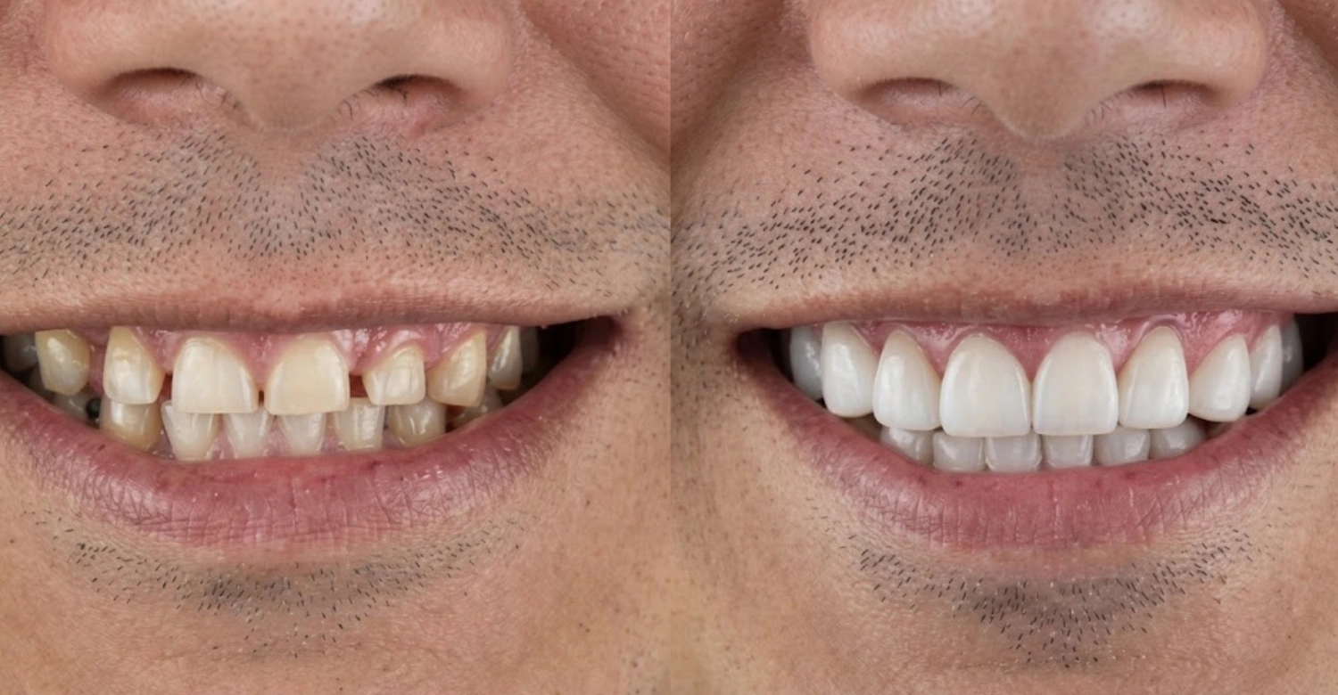 Smile Makeover Recovery inblog